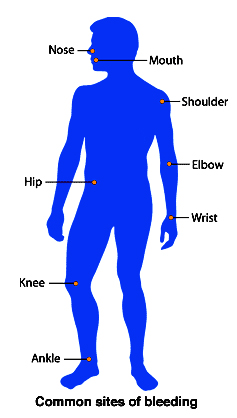 Symptoms and Common Places of Bleeding